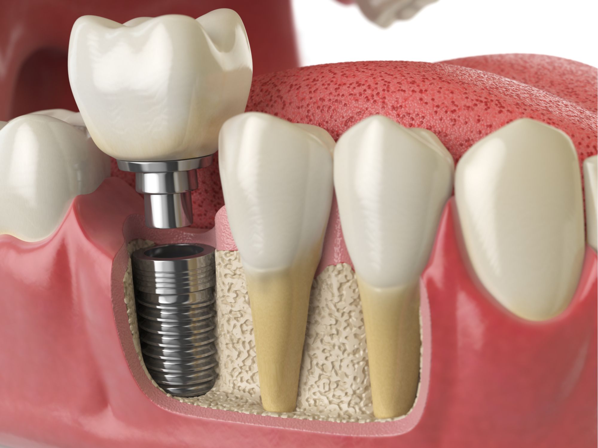 Does Medi Cal Cover Dental Implants?  