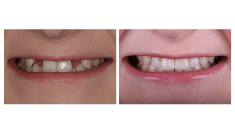 Missing lateral incisors