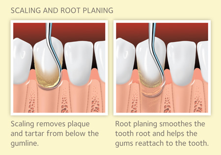Scaling & Root Planning